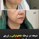 مجموعه زیبایی اولند تزریق بوتاکس و ژل و لیزر موهای زائد در دزفول