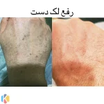 کلینیک زیبایی مهراد فیشال مزوتراپی مزونیدلینگ در گوهردشت کرج