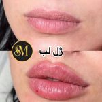 سالن زیبایی مهر مزونیدلینگ ژل لب تزریق بوتاکس در هفت تیر قم