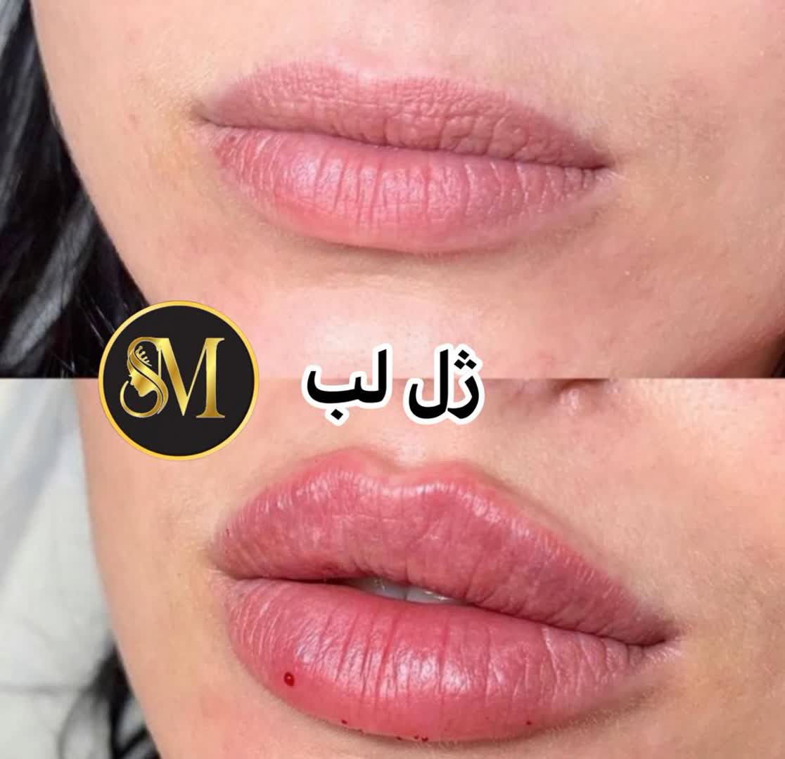 سالن زیبایی مهر مزونیدلینگ ژل لب تزریق بوتاکس در هفت تیر قم